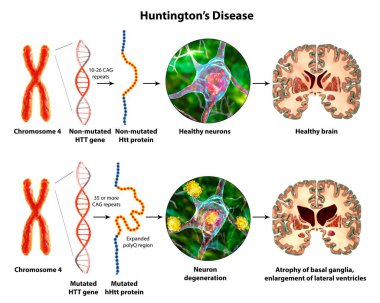 Molecular genesis of Huntington's disease, 3D illustration. Expansion of the CAG trinucleotide sequence in the htt gene causes production of mutated Huntingtin protein leading to neurodegeneration clipart