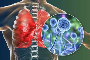 Lung mucormycosis, a lung disease caused by fungi Mucor, also known as black fungus, with close-up view of the fungi, 3D illustration. Covid-19 complication clipart