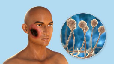 Cutaneous mucormycosis, siyah mantar olarak da bilinen mantar mantarının sebep olduğu bir hastalık, cilt eğriliğini ve mukoza mantarının yakın görüntüsünü gösteren 3 boyutlu bir illüstrasyon. Covid-19 komplikasyonu