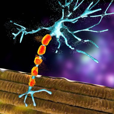 Motor nöronların bozulması, kavramsal 3 boyutlu çizim. Motor nöron hastalıkları amiyotrofik lateral skleroz, ilerici bulbar felci ve diğer nörodejeneratif bozukluklardır.