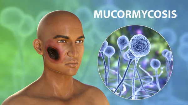 Cutaneous mucormycosis, a disease caused by fungi Mucor, also known as black fungus, 3D illustration showing skin leasion and closep view of Mucor fungus. Covid-19 complication