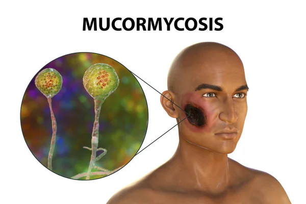 Cutaneous Mucormycosis Disease Caused Fungi Mucor Also Known Black Fungus — Stock Photo, Image