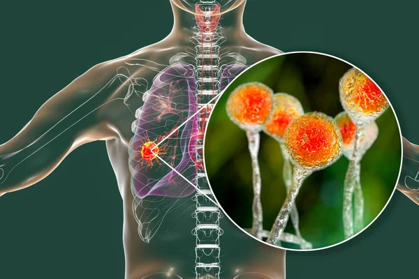 Tüdő Mucormycosis Egy Tüdőbetegség Okozta Gombák Nyálka Más Néven Fekete — Stock Fotó