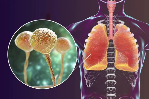 Lung mucormycosis, a lung disease caused by fungi Mucor, also known as black fungus, with close-up view of the fungi, 3D illustration. Covid-19 complication