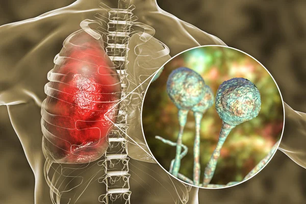 Tüdő Mucormycosis Egy Tüdőbetegség Okozta Gombák Nyálka Más Néven Fekete — Stock Fotó