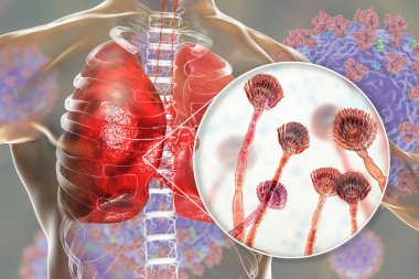 Pulmoner aspergillosis, küf mantarı Aspergillus tarafından akciğer dokusunun istilası, mantarın yakın görüntüsü, 3D çizim. Covid-19 komplikasyonu