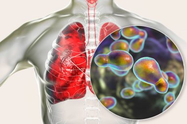 Pulmoner cryptococcosis, mantarları yakından gören mantar Cryptococcus neoformans tarafından akciğer dokusunun istilası, 3 boyutlu illüstrasyon. Covid-19 komplikasyonu