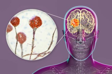 Brain mucormycosis, a brain lesion caused by fungi Mucor, also known as black fungus, with close-up view of the fungi, 3D illustration. Complication after Covid-19 clipart