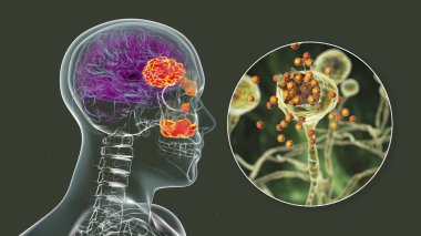 Rhinocerebral mucormycosis, a brain lesion and sinusitis caused by fungi Mucor, also known as black fungus, with close-up view of the fungi, 3D illustration. Complication after Covid-19 clipart