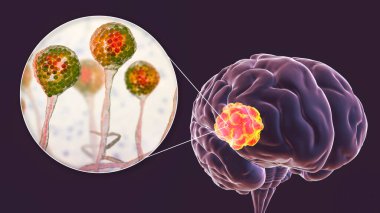 Brain mucormycosis, a brain lesion caused by fungi Mucor, also known as black fungus, with close-up view of the fungi, 3D illustration. Complication after Covid-19 clipart