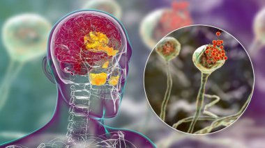 Rhinocerebral mukozis, bir beyin lezyonu ve mantar mukozitinden kaynaklanan sinüzit, ayrıca siyah mantar olarak da bilinir, mantarın yakın görüntüsü, 3 boyutlu illüstrasyon. Covid-19 'dan sonra karışıklık