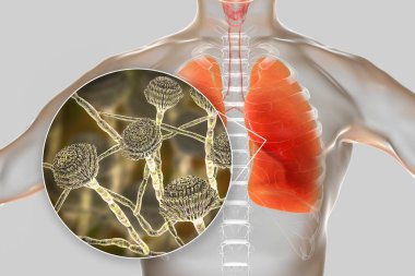 Pulmoner aspergillosis, küf mantarı Aspergillus tarafından akciğer dokusunun istilası, mantarın yakın görüntüsü, 3D çizim. Covid-19 komplikasyonu
