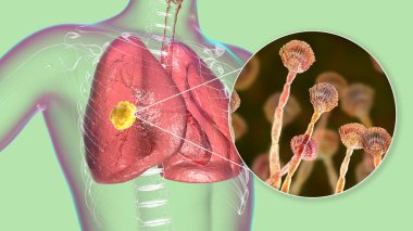 Pulmoner aspergillosis, küf mantarı Aspergillus tarafından akciğer dokusunun istilası, mantarın yakın görüntüsü, 3D çizim. Covid-19 komplikasyonu