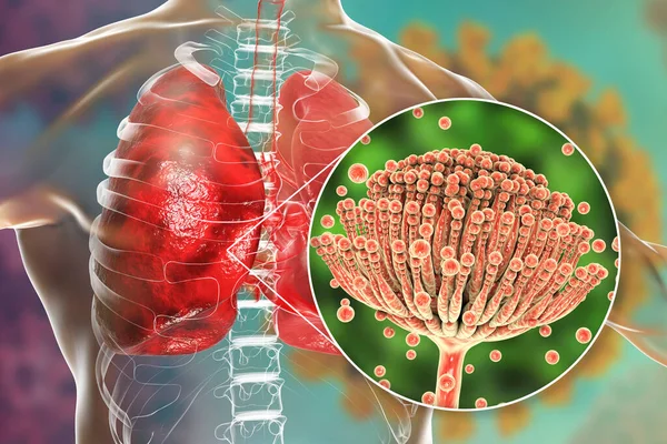 Pulmonary Aspergillosis Invasion Lung Tissue Mold Fungi Aspergillus Closeup View — Stock Photo, Image