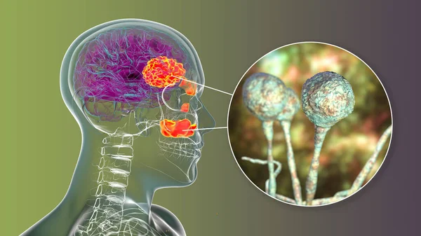 由真菌Mucor 也被称为黑色真菌 引起的鼻脑膜粘菌病 一种脑部病变和鼻窦炎 近距离观察真菌 3D说明 Covid 19之后的并发症 — 图库照片