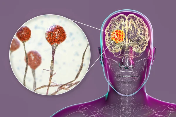 Gehirnschleimhaut Eine Durch Pilze Verursachte Hirnläsion Auch Als Schwarzer Pilz — Stockfoto