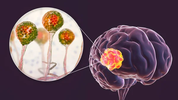 脑粘液菌病 一种由真菌Mucor引起的脑损伤 也被称为黑色真菌 与真菌的近距离观察 3D说明 Covid 19之后的并发症 — 图库照片