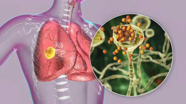 Mucormicose Pulmonar Uma Doença Pulmonar Causada Por Fungos Mucor Também — Fotografia de Stock