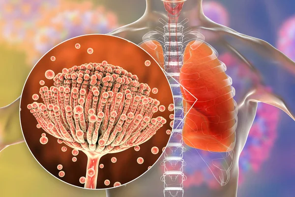 Lungenaspergillose Invasion Eines Lungengewebes Durch Schimmelpilze Aspergillus Mit Nahaufnahme Der — Stockfoto