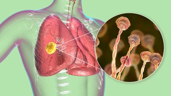 Lungenaspergillose Invasion Eines Lungengewebes Durch Schimmelpilze Aspergillus Mit Nahaufnahme Der — Stockfoto