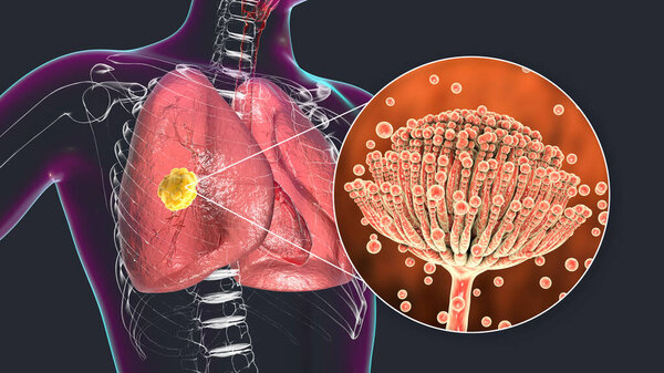 Pulmonary aspergillosis, invasion of a lung tissue by mold fungi Aspergillus with closeup view of the fungi, 3D illustration. Covid-19 complication