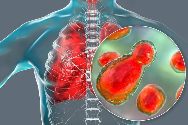 Pulmonalis Cryptococcosis Invázió Tüdőszövet Élesztő Gombák Cryptococcus Neoformans Közelkép Gombák — Stock Fotó