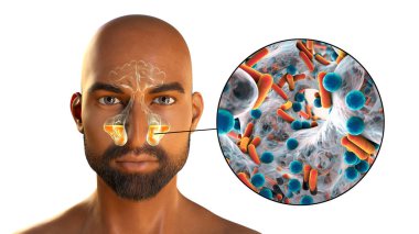 Sinüzit, paranasal boşlukların iltihaplanması. 3 boyutlu illüstrasyon, bir erkekte maksiller sinüslerde iltihaplanma ve sinüzite neden olan bakterilerin yakın çekim görüntülerini gösteriyor.