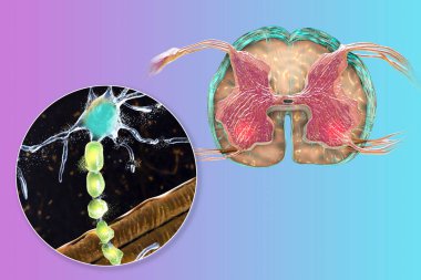 Motor nöron hastalıkları, omuriliğin ön boynuzlarında motor nöronların dejenerasyonunu gösteren 3 boyutlu çizimler. Amyotrofik lateral skleroz ve diğer motor nöron bozuklukları