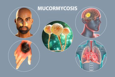 Mukomozun klinik formları, mukoza mantarlarının neden olduğu bir hastalık, ayrıca siyah mantar olarak da bilinir, ya da ekmek küfü, 3 boyutlu çizim. Bağışıklık sistemi çökmüş kişilerde mantar enfeksiyonları, Covid-19 komplikasyonu