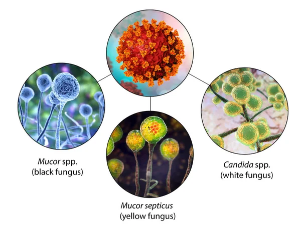 Complications Fongiques Covid Illustration Mycoses Associées Covid Mucormycose Champignon Noir — Photo
