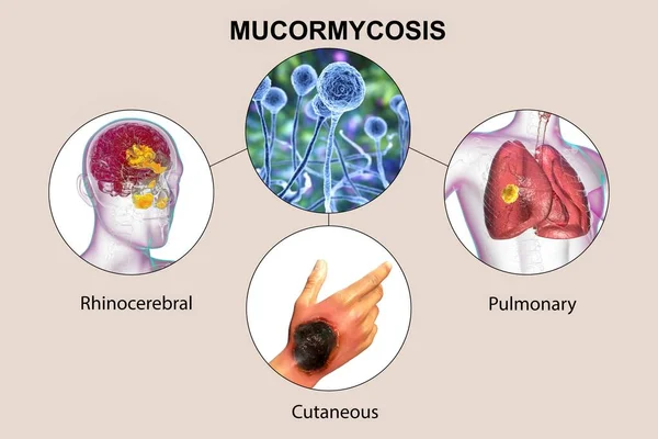 Clinical Forms Mucormycosis Disease Caused Mucor Fungi Also Known Black — Stock Photo, Image