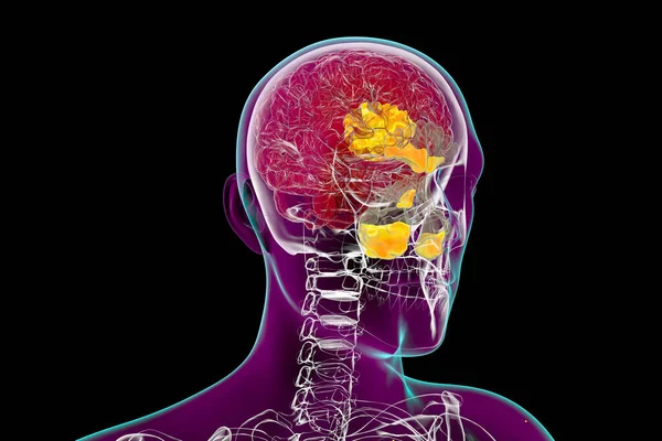 Rhinozerebrale Schleimhautentzündung Eine Gehirnläsion Und Sinusitis Die Durch Die Pilze — Stockfoto