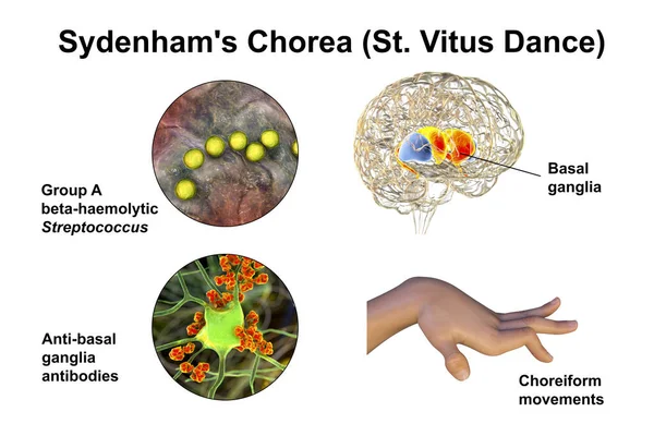 Sydenham Koreası Streptococcus Enfeksiyonundan Kaynaklanan Otoimmün Bir Hastalık Beyin Bazal — Stok fotoğraf