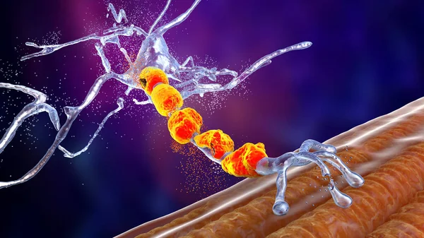 Degradation of motor neurons, conceptual 3D illustration. Motor neuron diseases are a group of neurodegenerative disorders including amyotrophic lateral sclerosis, progressive bulbar palsy and other