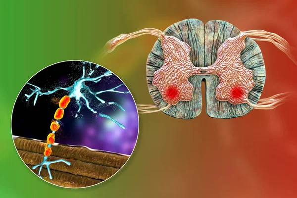 Motor neuron diseases, 3D illustration showing degeneration of motor neurons in anterior horns of spinal cord. Amyotrophic lateral sclerosis and other motor neuron disorders