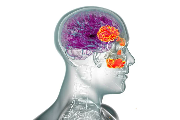 Rhinocerebrale Mucormycose Een Hersenletsel Sinusitis Veroorzaakt Door Schimmels Mucor Ook — Stockfoto