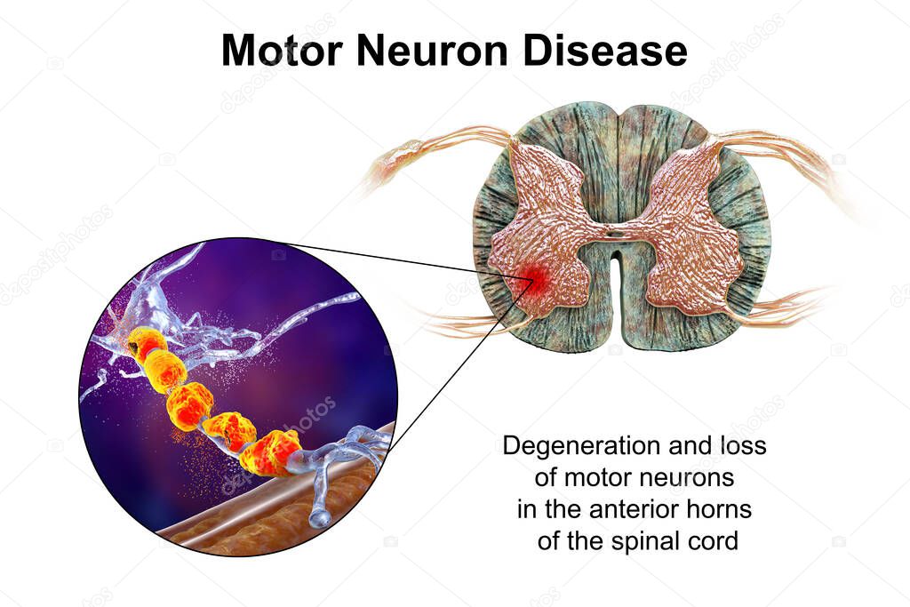Motor neuron diseases, 3D illustration showing degeneration of motor neurons in anterior horns of spinal cord. Amyotrophic lateral sclerosis and other motor neuron disorders