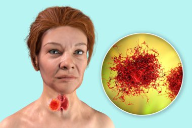 Thyroid cancer. 3D illustration showing thyroid gland with tumor inside human body and closeup view of thyroid cancer cells clipart