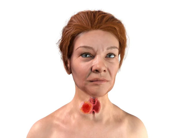 Рак Щитовидной Железы Иллюстрация Показывающая Щитовидную Железу Опухолью Внутри Человеческого — стоковое фото