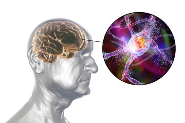 Bunama ve Alzheimer hastalığı tıbbi konsepti, 3 boyutlu illüstrasyon. Hafıza kaybı, beyin yaşlanmaları. Kavramsal görüntü, yaşlılıkta beyin fonksiyonlarında ilerleyen bir bozukluk olduğunu gösteriyor. Nörodejenerasyon