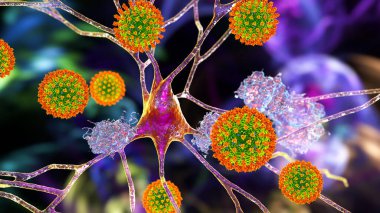 Covid-19 ve bunama. Covid-19 'un nöropsikiyatrik ardılı. Üç boyutlu illüstrasyon. Koronavirüsler nöronlara zarar verir. Beyin dokusundaki amiloit plakları nörodejenerasyon belirtisi..