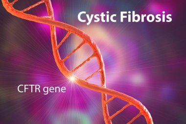 Kistik fibroz, CFTR genindeki mutasyondan kaynaklanan genetik bir bozukluktur, akciğerleri, pankreası ve diğer organları etkileyen otozomal çekinik bir şekilde kalıtsaldır, kavramsal 3D çizim