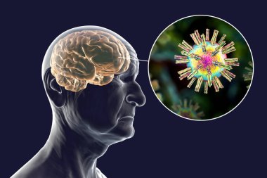 Bunama rolünde uçuk virüsleri. Kavramsal 3 boyutlu illüstrasyon, beyin fonksiyonlarında ilerleyen bozukluklar ve nöronları etkileyen uçuk virüsleri olan yaşlı bir insanı gösteriyor.