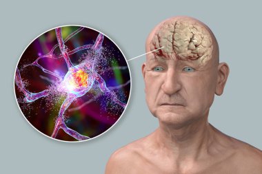 Bunama ve Alzheimer hastalığı tıbbi konsepti, 3 boyutlu illüstrasyon. Hafıza kaybı, beyin yaşlanmaları. Kavramsal görüntü, yaşlılıkta beyin fonksiyonlarında ilerleyen bir bozukluk olduğunu gösteriyor. Nörodejenerasyon