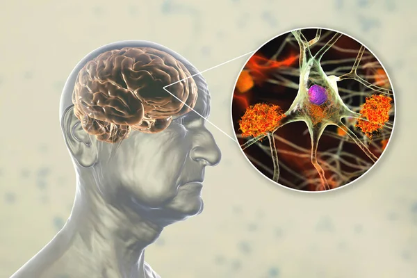 認知症 概念的な3Dイラストは 脳機能の進行性障害を持つ高齢者を示しています 脳内のアミロイドプラーク 神経線維化の角度と神経ネットワークの破壊 — ストック写真