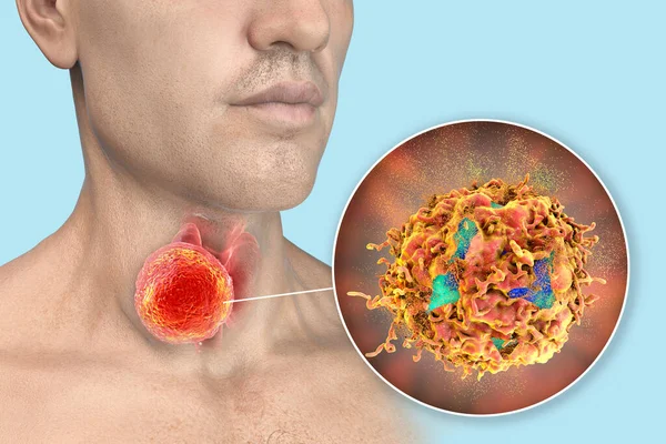 Thyroid cancer treatment concept. 3D illustration showing thyroid gland with tumor inside human body and closeup view of disintegrating thyroid cancer cells