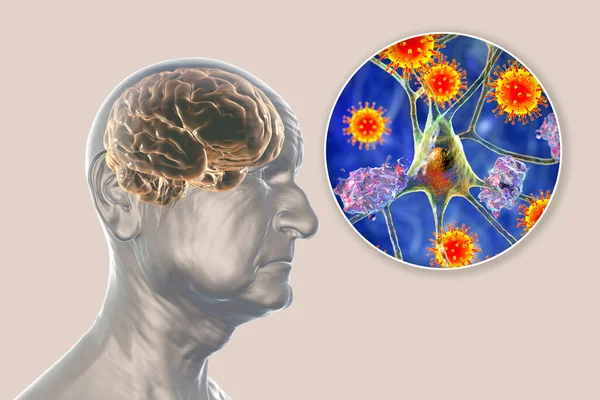 stock image Covid-19 and dementia. 3D illustration. Neuropsychiatric sequelae of Covid-19. Infectious etiology of dementia. An elderly person with progressive loss of brain functions and viruses affecting neurons.