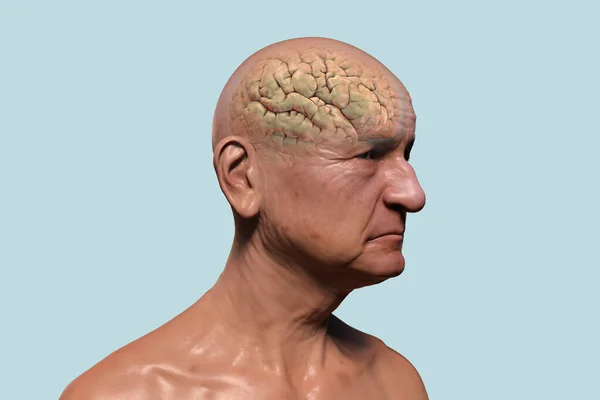 An elderly person with highlighted brain. Dementia, conceptual 3D illustration showing progressive impairment of brain functions in elderly age.