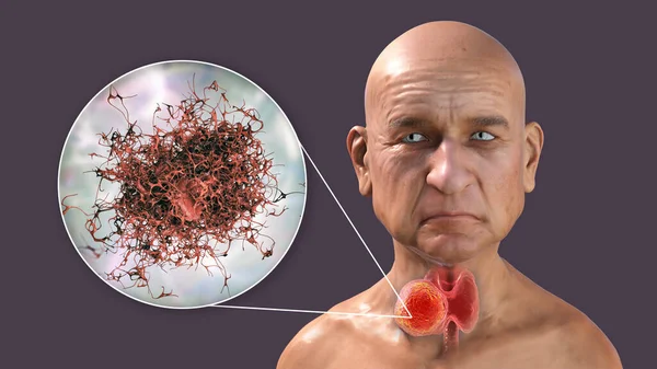 Καρκίνος Του Θυρεοειδούς Απεικόνιση Που Δείχνει Θυρεοειδή Αδένα Όγκο Μέσα — Φωτογραφία Αρχείου