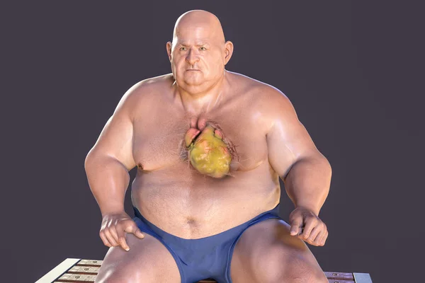 Παχύσαρκη Καρδιά Στο Υπέρβαρο Άνθρωπο Εικόνα Έννοια Της Παχυσαρκίας Και — Φωτογραφία Αρχείου